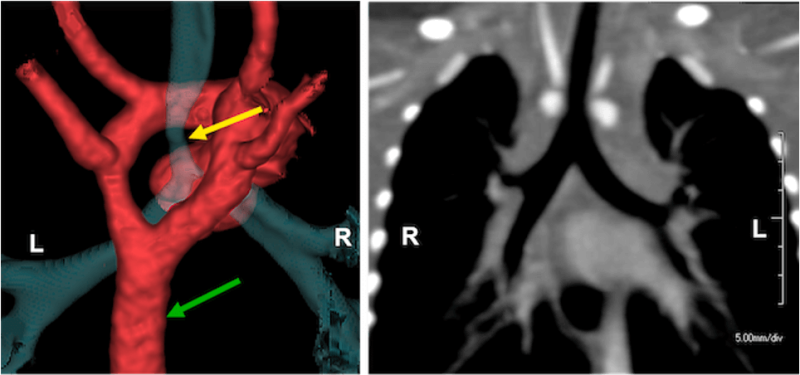 Great Vessel Anomalies | Pediatric Radiology